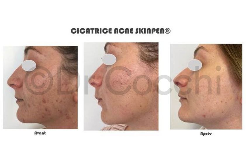 Microneedling avant et après - 742653
