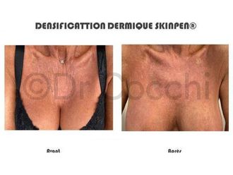 Microneedling avant et après - 742654