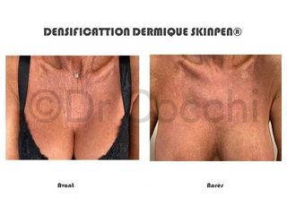 Avant après Microneedling - Dr Christian Cocchi