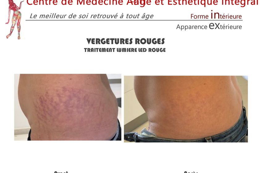 Vergetures avant et après - 843062