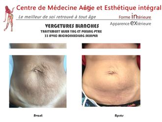 Vergetures avant et après - 843063
