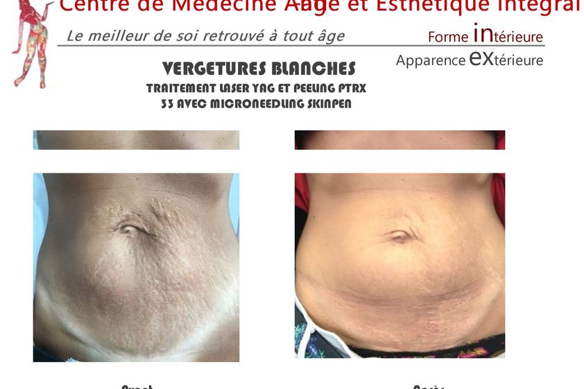Vergetures avant et après - 843063