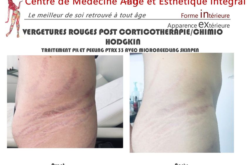 Vergetures avant et après - 843066