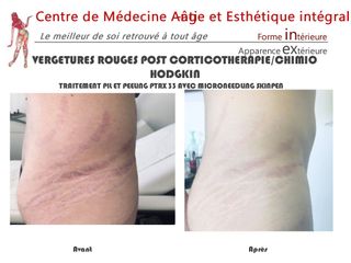 Vergetures - Dr Christian Cocchi