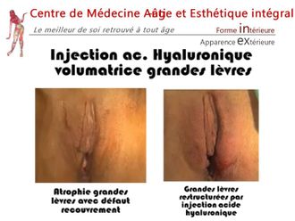 Nymphoplastie avant et après - 843076