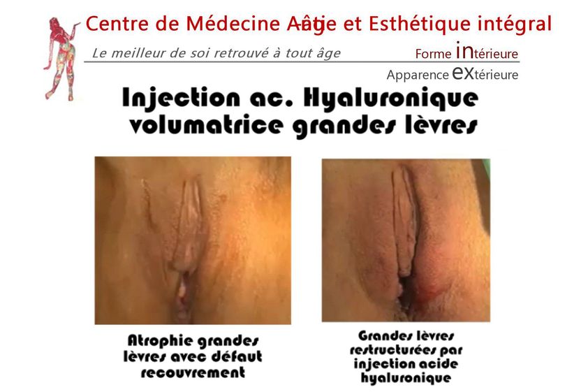 Nymphoplastie avant et après - 843076