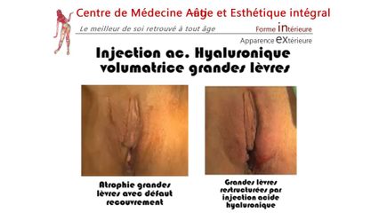 Nymphoplastie - Dr Christian Cocchi