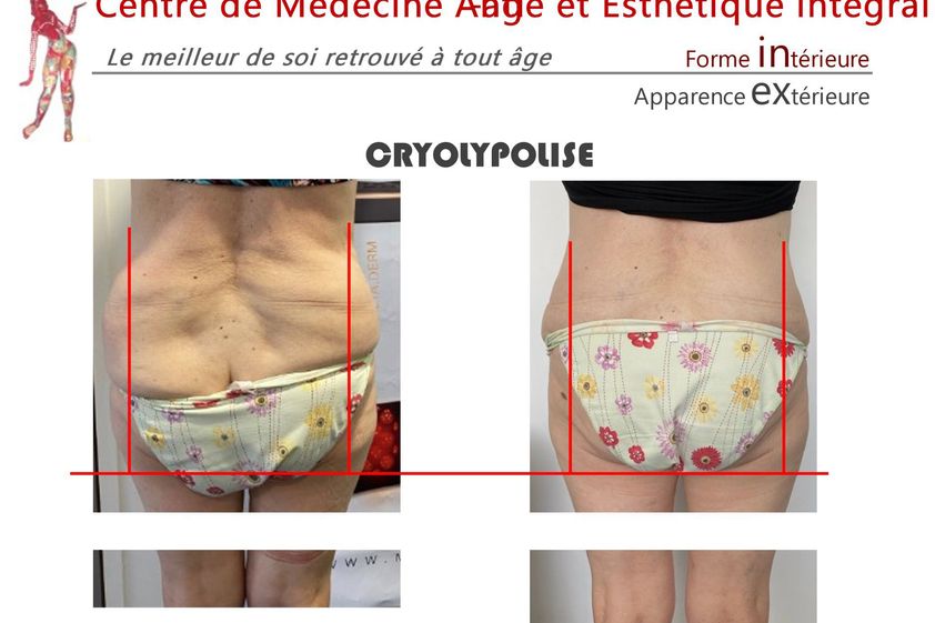 Cryothérapie avant et après - 843080