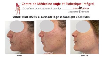 Traitement anti-acné - Dr Christian Cocchi