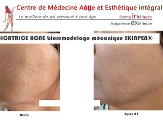 Traitement anti-acné - 843089