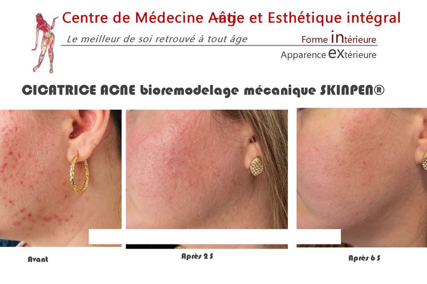 Traitement anti-acné avant et après - 843090