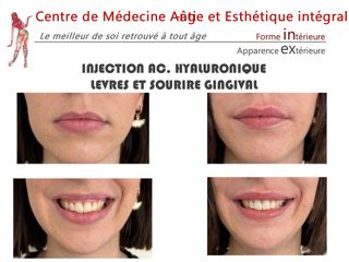 Augmentation des lèvres - Dr Christian Cocchi