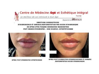 Augmentation des lèvres - Dr Christian Cocchi