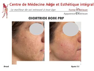 Traitement anti-acné - 843104