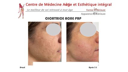 Traitement anti-acné - Dr Christian Cocchi