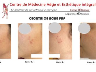 Traitement anti-acné - 843105