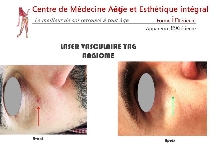 Verrues avant et après - 843113