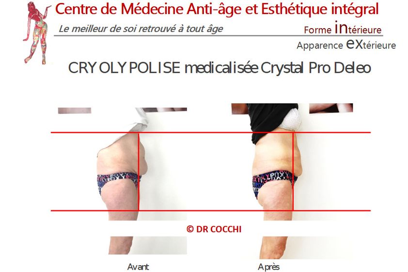Cryolipolyse avant et après - 851217