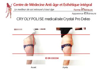 Cryolipolyse - Dr Christian Cocchi