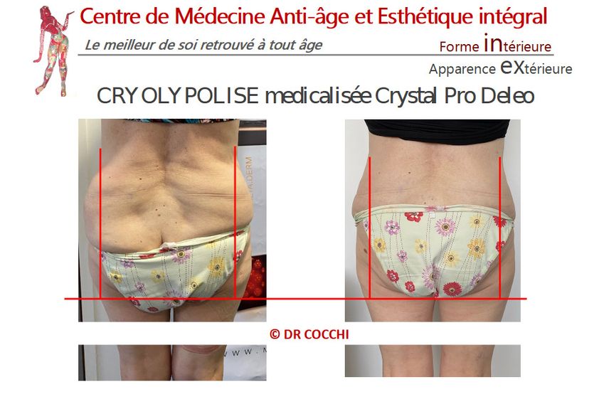 Cryolipolyse avant et après - 851218