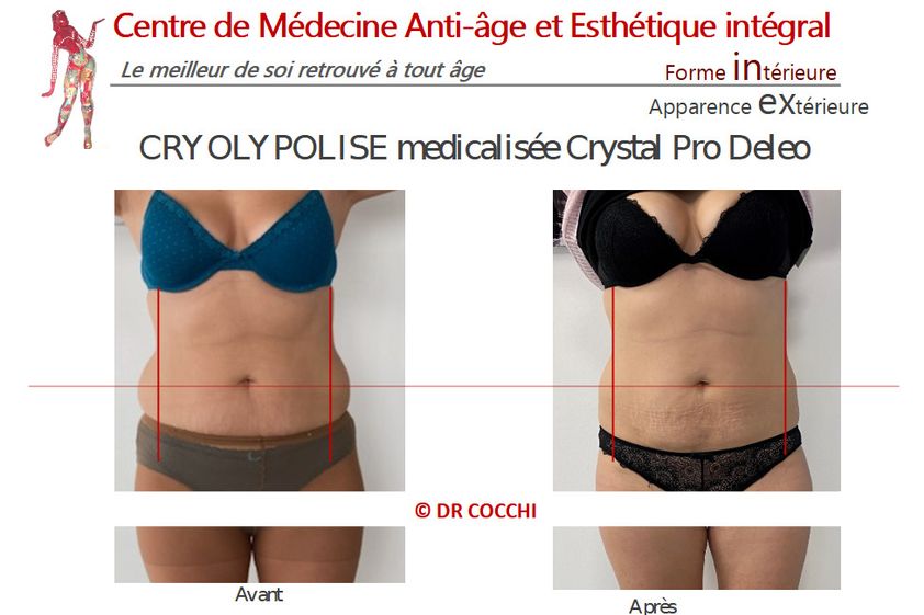 Cryolipolyse avant et après - 851219