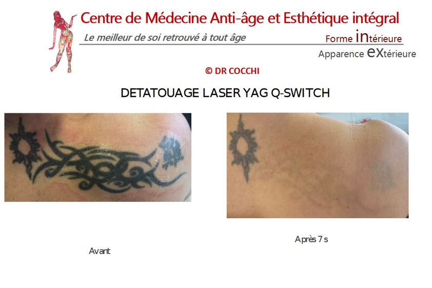 Détatouage avant et après - 851224