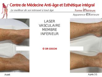 Traitement laser avant et après - 861035