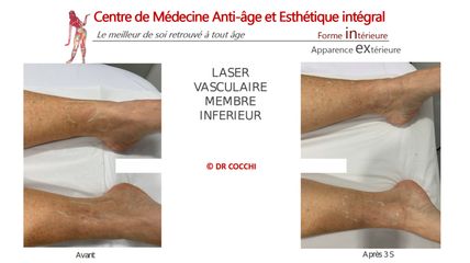 Laser vasculaire - Dr Christian Cocchi