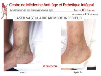 Traitement laser avant et après - 861036