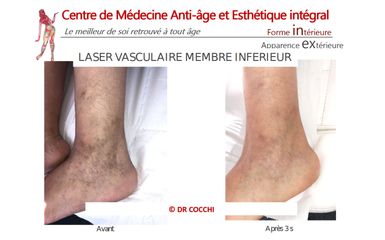 Laser vasculaire - Dr Christian Cocchi