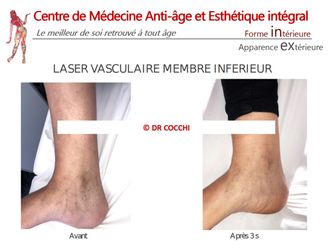 Traitement laser avant et après - 861037