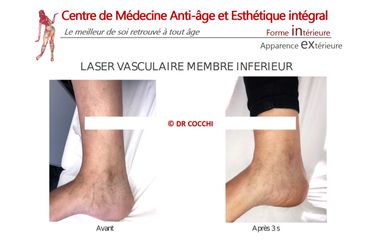 Laser vasculaire - Dr Christian Cocchi
