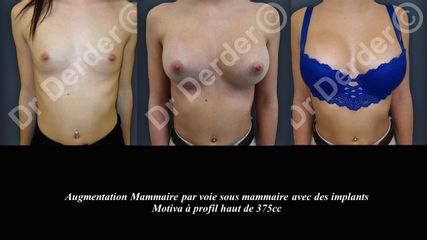 Avant après Augmentation mammaire