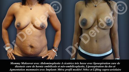 Avant après Augmentation mammaire