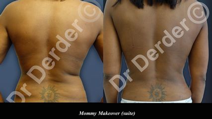 Avant après Abdominoplastie