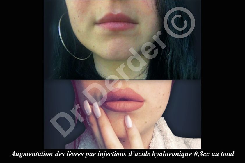 Augmentation des lèvres avant et après - 689616