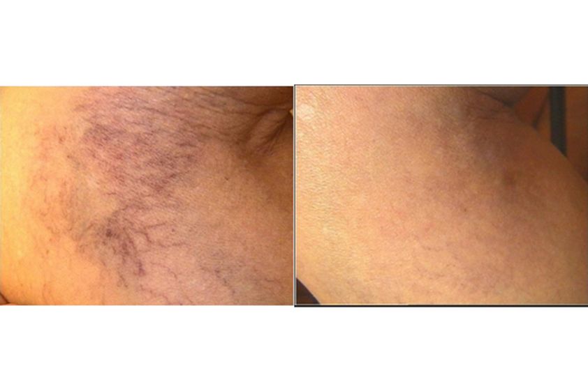 Varices avant et après - 542962