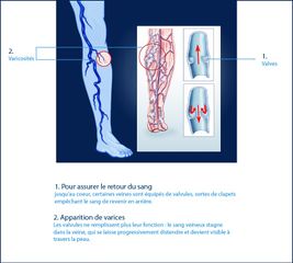 Varicosités des membres inférieurs