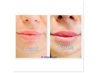 Augmentation des lèvres - Dr Alban Pagès