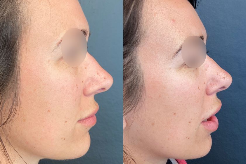 Traitement anti-cellulite avant et après - 826507