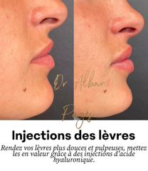 Augmentation des lèvres - Dr Alban Pagès