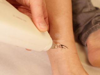 Détatouage laser
