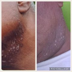 Peeling - Dr Florence Kadji