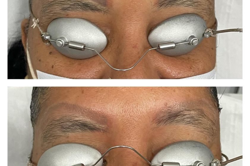 Dermopigmentation avant et après - 811229