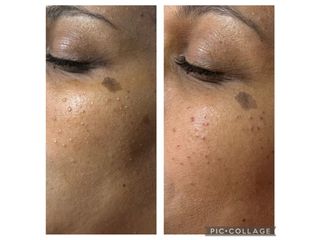 Traitement anti-acné - Dr Florence Kadji