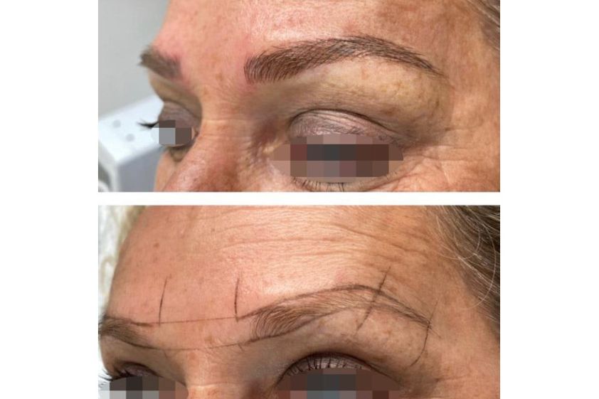 Dermopigmentation avant et après - 816175