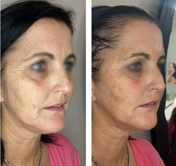 Full Face Acide Hyaluronique - Dr Florence Kadji