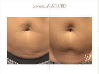 Avant après Cryolipolyse