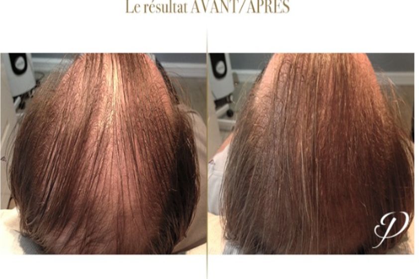 Mésothérapie avant et après - 560507