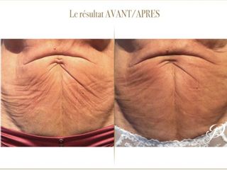 Avant après Radiofréquence tripolaire